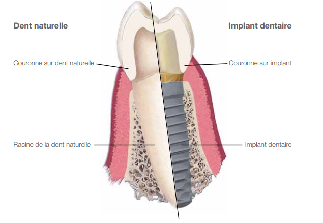 Description implant