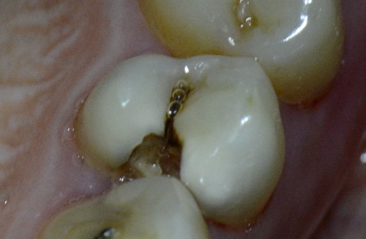 Carie occlusal sur une prémolaire