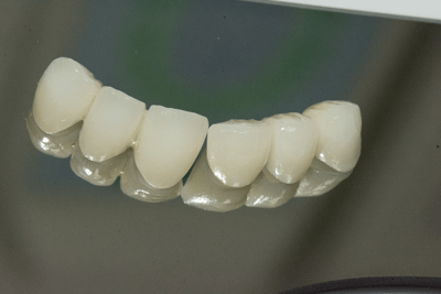 Bridge Zircone 6 dents